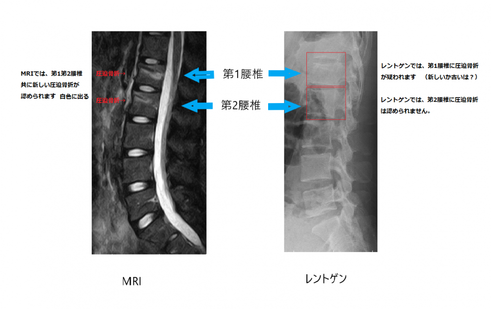 腰痛について Mri撮影の重要性